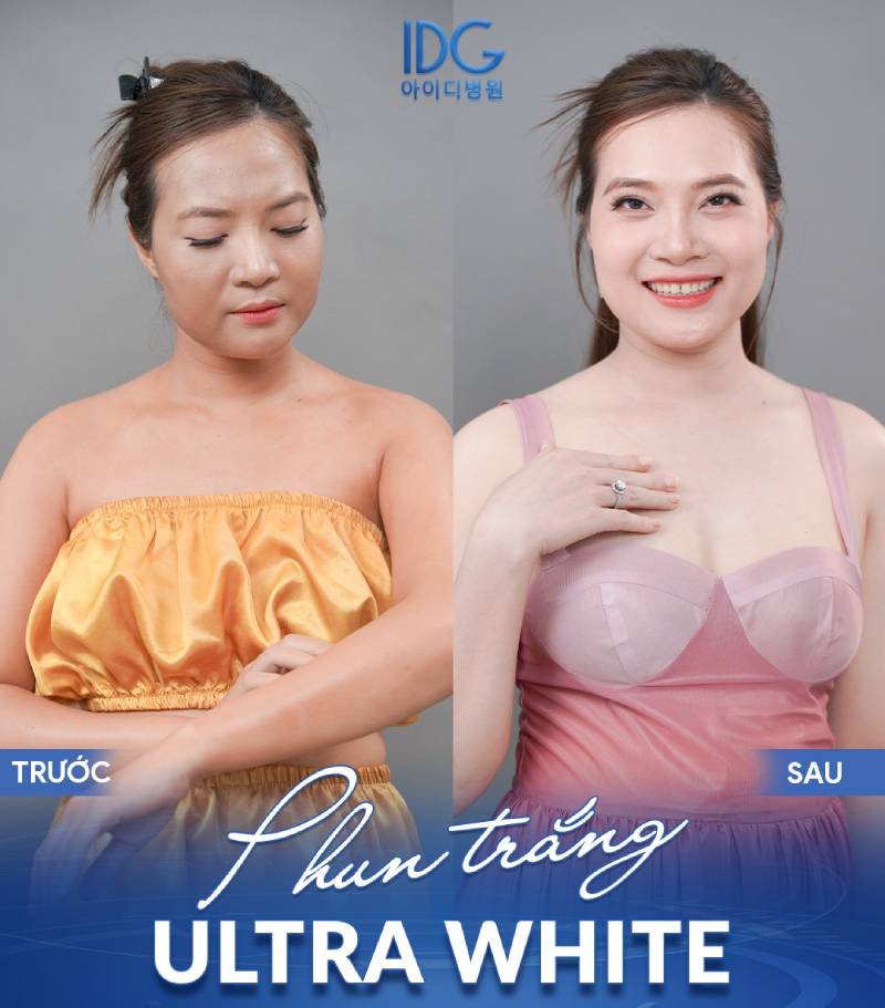 công nghệ phun trắng ultra white