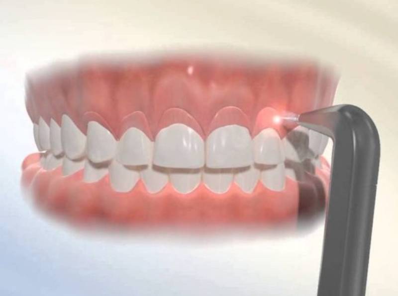 cắt lợi bằng laser